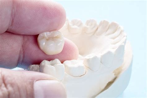 What Are The Different Types Of Dental Crowns Montgomery Al