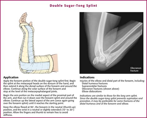 Splinting Techniques Clinical Tree