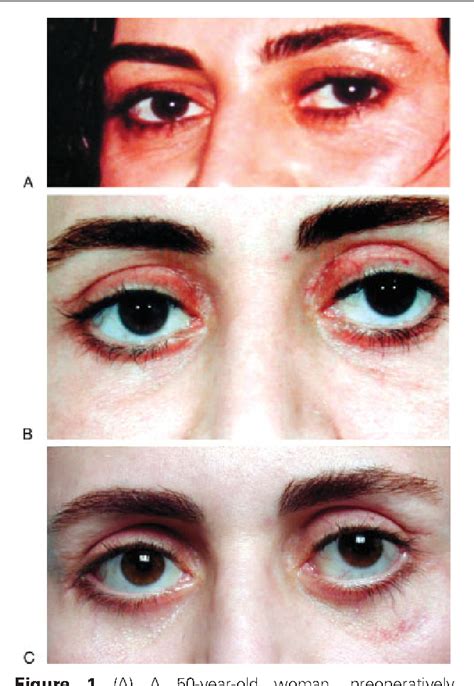 Figure 1 from Lateral canthal surgery. | Semantic Scholar