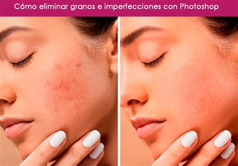 C Mo Eliminar Granos E Imperfecciones Con Phosothop Muy F Cil