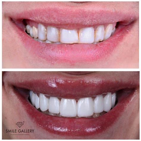 Вставить виниры в Новосибирске недорого и быстро | стоматология Smile ...