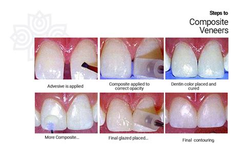 Composite Veneers – Affinity Dental Group