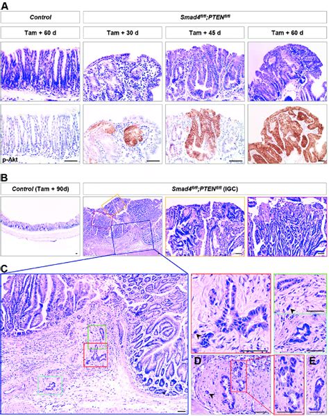 Gastric Adenocarcinoma Was Driven By Antral Lgr5 Stem Cells With The