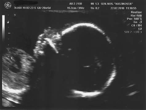 Prenatal Diagnosis Of Trisomy Mosaicism Associated With Hypoplastic