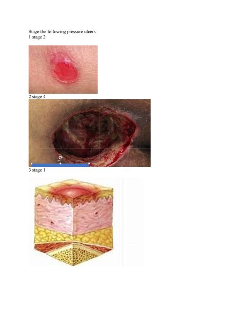 Pressure Ulcer Day 1 16 1 Stage The Following Pressure Ulcers 1 Stage 2 2 Stage 4 4 Stage 8