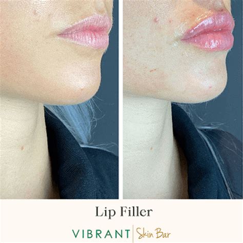 Lip Flip Vs. Filler: What Are the Differences Between Two Lip Treatments