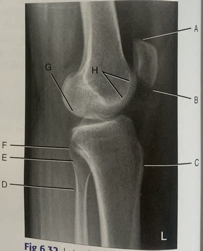 Lateral Knee Flashcards Quizlet