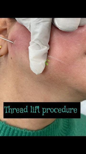 Dr Ashima Goel Dermatologist On Instagram Thread Lift To Create A