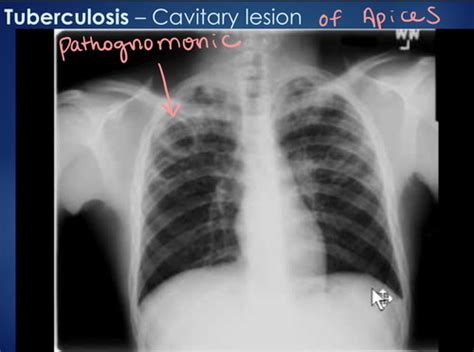 Chest Xray Flashcards Quizlet