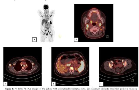 Figure From Hemophagocytic Lymphohistiocytosis Secondary To