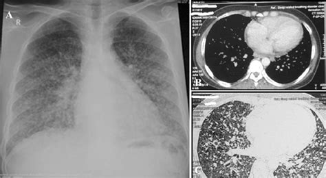 Chest Roentgenogram Showing Bilateral Reticular Macro And Micro Nodules