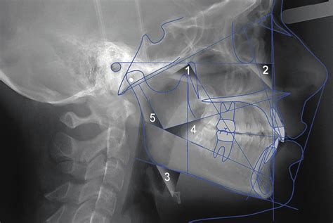 Cephalometric Measurements Used To Define Vertical Facial Pattern