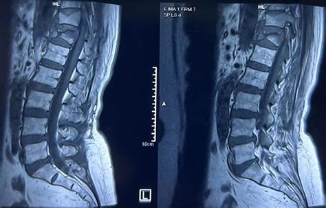 Meyer Spinal Surgery Robot HEFEI MEYER OPTOELECTRONIC TECHNOLOGY INC