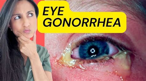 Gonorrhea Eyes