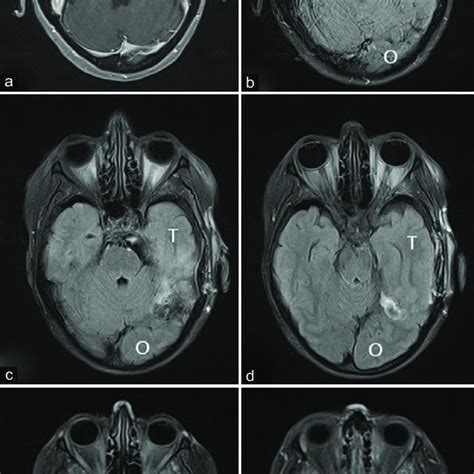 Preoperative Magnetic Resonance Imaging Mri A T1 Gadolinium B Download Scientific