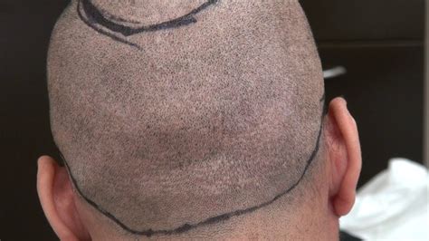 Fue Donor Scar 1 Year Minimal Scars After Fue Hair Transplant Surgery Follicular Unit Extraction