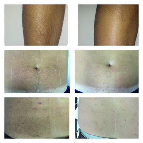 Elysion Pro Epilare Laser Barbati Shining Body Sibiu