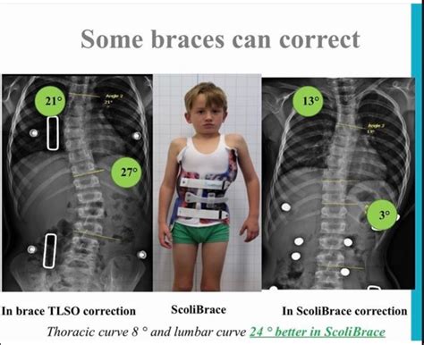 Strauss Scoliosis Correction Keeping Patients Ahead Of The Curve