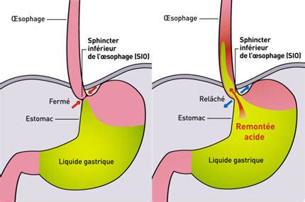 Reflux Gastro Oesophagien ou RGO Ostéopathe spécialisé en phoniatrie