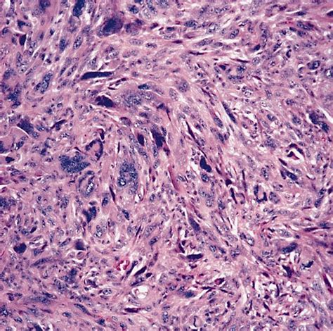 Pathology Outlines Undifferentiated Unclassified Sarcoma