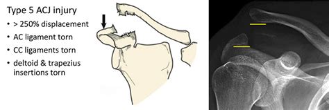 Acromioclavicular Jtacjt Cambridge Shoulder