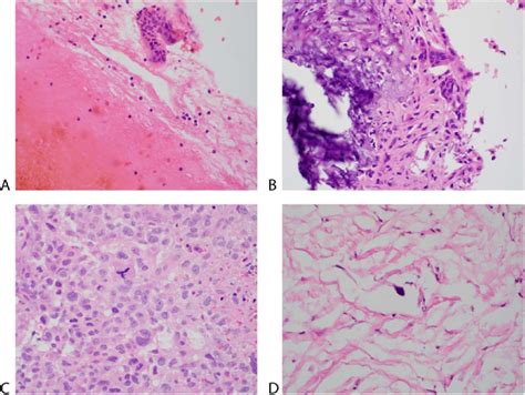 A D Histologic Sections Show Both ABC And Telangiectatic Osteosarcoma