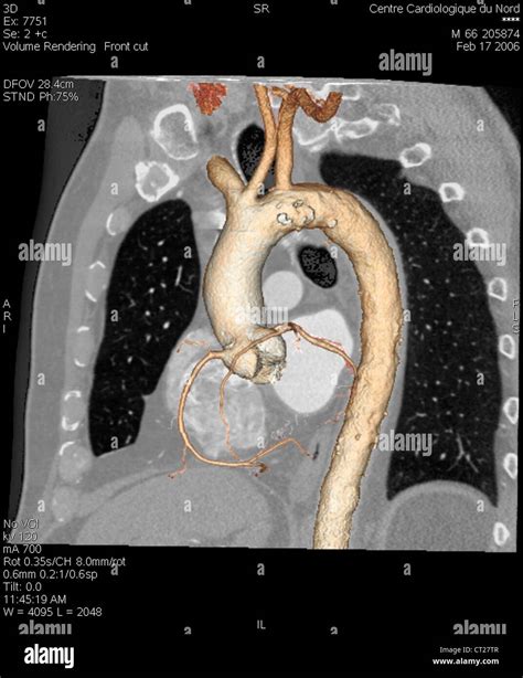 Aorta D Scan Stock Photo Alamy