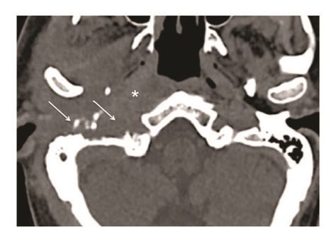 A Inflammatory Infiltration At The Level Of The Prevertebral And