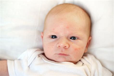 Baby With Atopic Dermatitis Getting Cream Put Care And Prevention Of