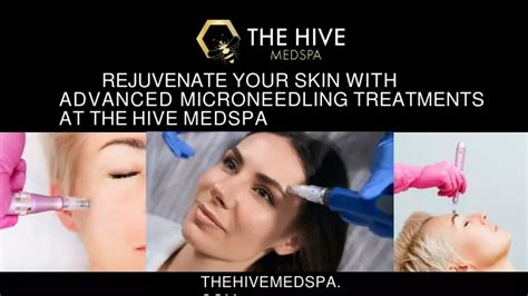 Ppt Rejuvenate Your Skin With Advanced Microneedling Treatments At