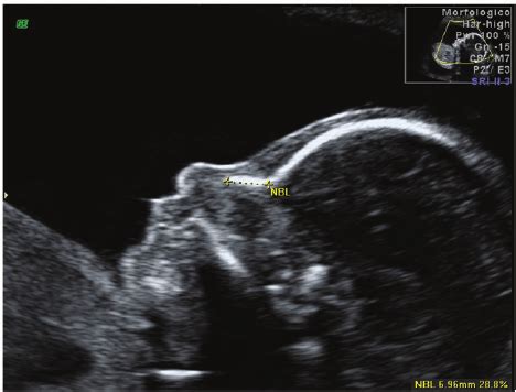 Down Syndrome Ultrasound Nasal Bone