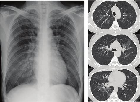 Chest X Ray And Computed Tomography Ct Scan On Admission Showing Download Scientific Diagram