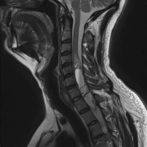 Pre Operative T2 Weighted Sagittal MRI Of The Cervical Spine Showing A