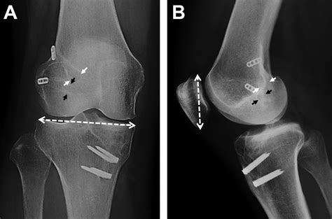 Double Bundle Anterior Cruciate Ligament Reconstruction Using Hamstring