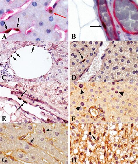 Photographs Show Dual Immunohistochemical Stain For Ki 67 And CD31 In