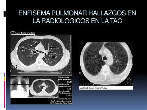 Ppt Enfermedad Pulmonar Obstructiva Cr Nica Powerpoint Presentation