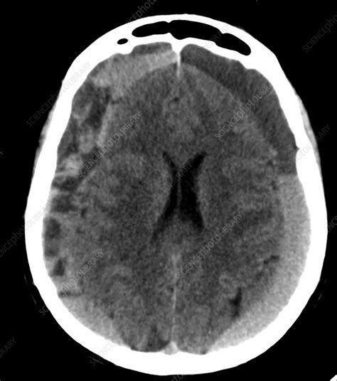 Subdural hematoma, CT scan - Stock Image - C039/3588 - Science Photo ...