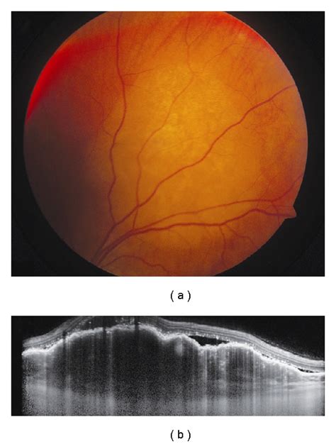 Choroidal Metastasis A Amelanotic Choroidal Metastasis In A Patient