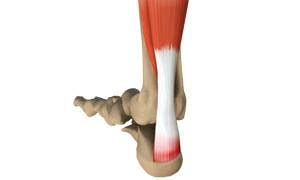 Insertional Achilles Tendonitis Greater Manchester | High Volume ...