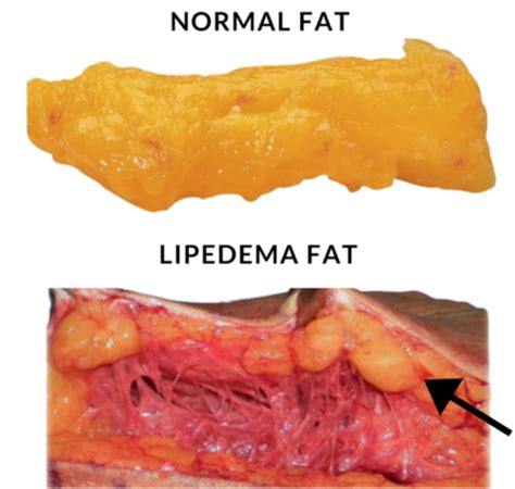 Lipedema Ac Mulo Desproporcional De Gordura Nas Pernas Tem Divirta Se