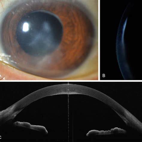 Preoperative Slit Lamp Photographs A B Using As Oct The Precise