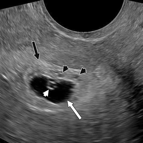 Gestational Trophoblastic Disease Clinical And Imaging Features Radiographics