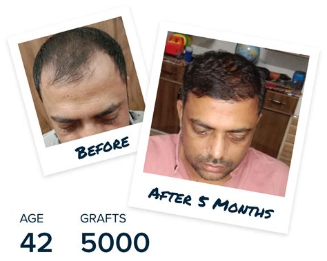 Hair Transplant Surgery Procedure Type And Side Effects