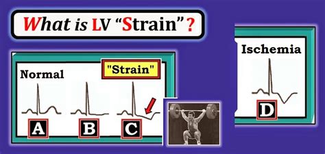 ECG Interpretation: ECG Blog #92 (Basic Concepts-5) – LVH