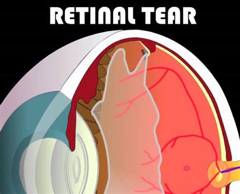 Floaters & Flashes Lexington | Retinal Tears Louisville | Retina Associates