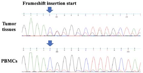 Sanger Sequencing Electropherogram Confirming A Frameshift Deletion And