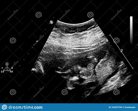 Ultrasound Scherm Met Foetale Echocardiografie Stock Afbeelding Image