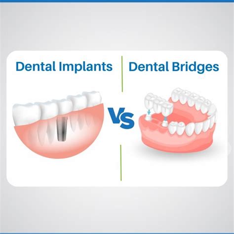 Dental Implant Vs Bridge Pros Cons Which Is Better