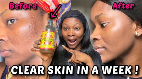 5 Methods To Get Rid Of Acne With Apple Cider Vinegar In A Week 100 Effective Youtube