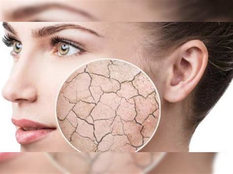 Solution For Dry And Dull Skin In Winter This Tips Will Help You